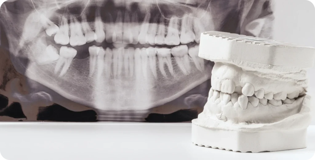 Implant dentaire immediat