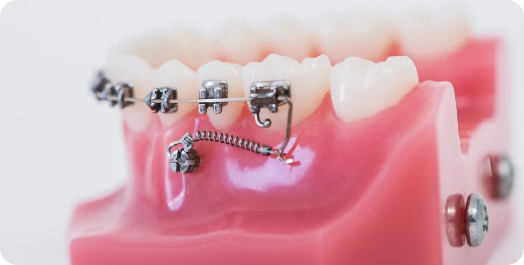 Pose de plaque d'ancrage