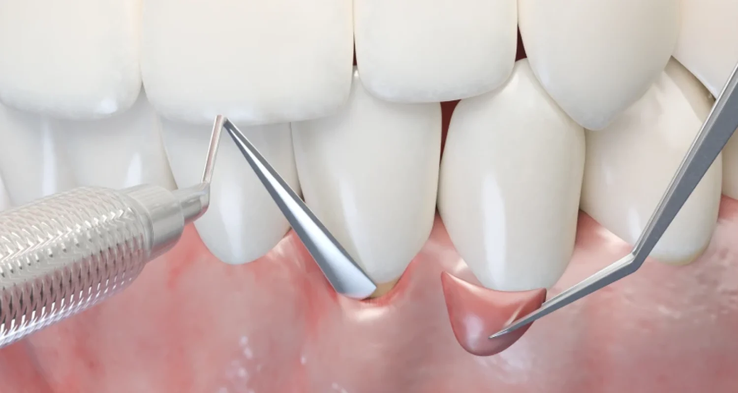 Module 3 : Chirurgie muco gingivale